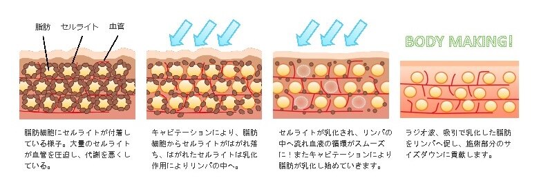 セルライト